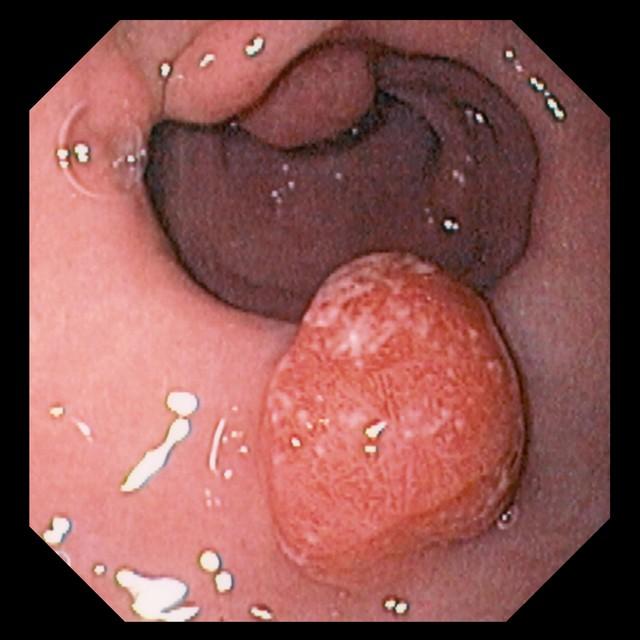 胃息肉為什麼切瞭又長出來，消化胃鏡醫生說：有一點情況要註意！插图2