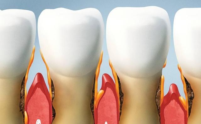 牙齦是腫瘤“放大鏡”？牙齦若出現這些問題，趁早調理不能拖插图2