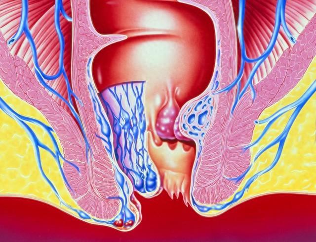 “難以啟齒”的肛門癌 你瞭解嗎？醫生：出現4個癥狀 及時就醫檢查缩略图