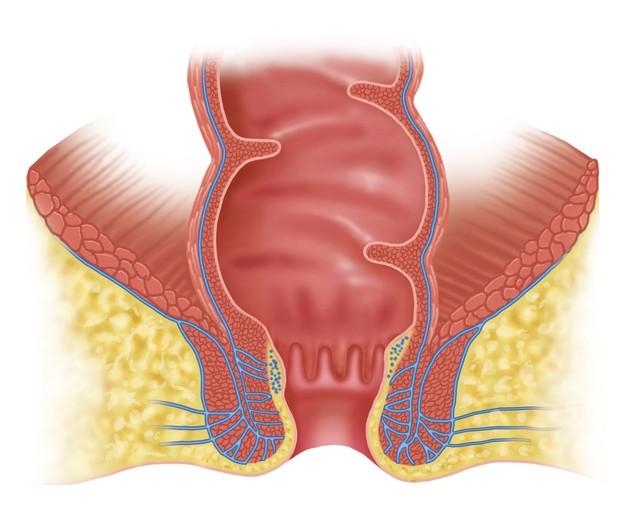 “難以啟齒”的肛門癌 你瞭解嗎？醫生：出現4個癥狀 及時就醫檢查插图1