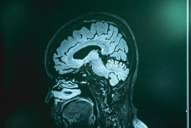 年紀大瞭害怕腦萎縮？醫生：這3種藥用得越早，效果或越好缩略图