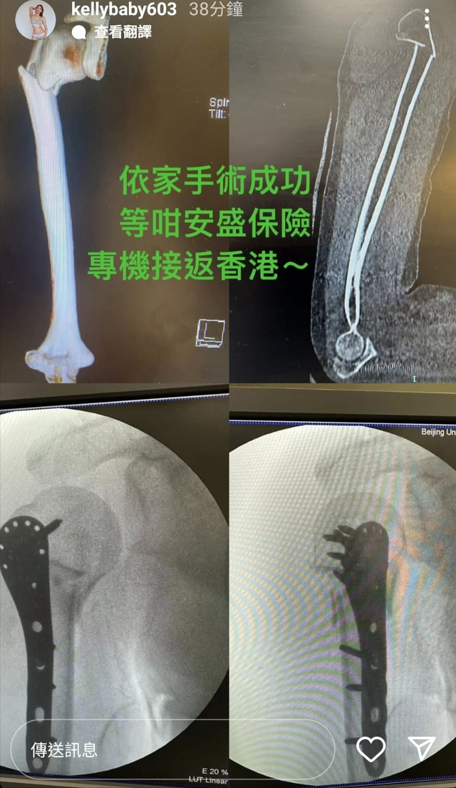 港版林志玲長白山旅遊遇意外！苦熬10小時飛北京手術等專機返港插图6