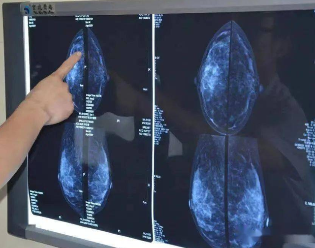 51歲女老板查出乳腺癌，選擇保守治療，直言：沒法理解全切的女人插图7